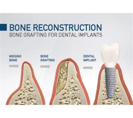 NanoHydroxyapatite - A Champion for Bone Regeneration and Dental Implants!